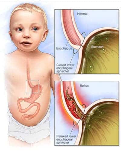 incline sleeper for baby with reflux